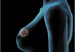 乳腺癌靶向治療藥品——拉帕替尼