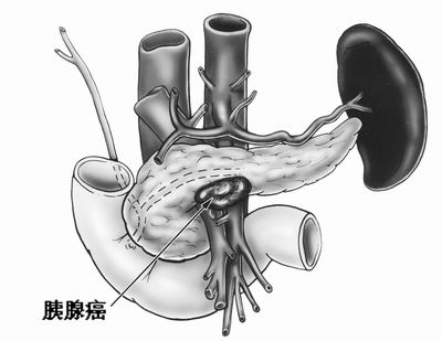 胰腺癌為何如此難治