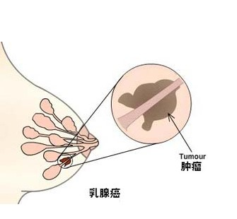 乳房異常可能是乳腺癌的早期癥狀