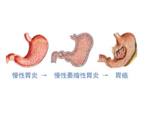 慢性胃炎會發展成胃癌嗎