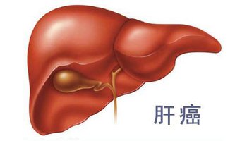 警惕肝癌的早期癥狀 