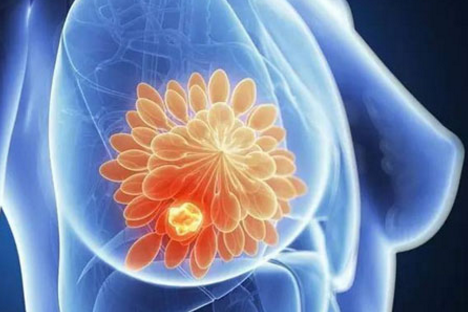 三陰性乳腺癌的免疫療法
