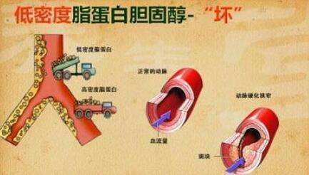 降膽固醇藥物inclisiranⅢ期臨床試驗：每年2次給藥顯著降低LDL-C_香港濟民藥業