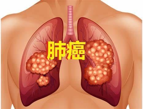 歐盟批準Imfinzi(英飛凡)：一線治療廣泛期小細胞肺癌(ES-SCLC)！_香港濟民藥業