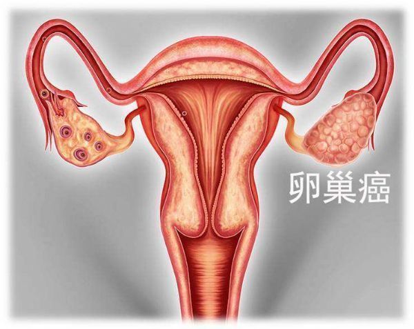 葛蘭素史克抗癌藥Zejula（尼拉帕利）用于一線單藥維持治療鉑敏感卵巢癌在歐盟獲批！_香港濟民藥業
