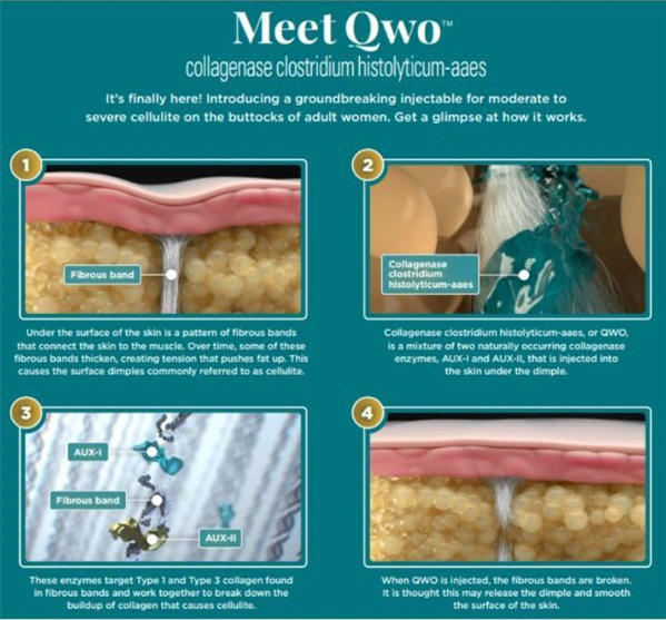 首款“橘皮組織”新藥Qwo(溶組織梭菌膠原酶，CCH)，顯著改善臀部外觀_香港濟民藥業