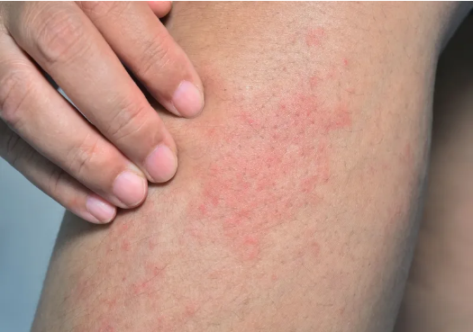 ?Odevixibat (Bylvay) 治療進行性家族性肝內膽汁淤積癥